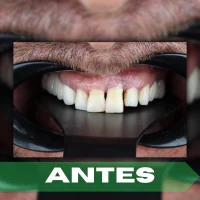 full-arch antes