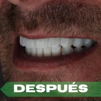 full-arch después