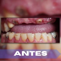 Periodoncia antes