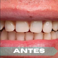 Carillas antes