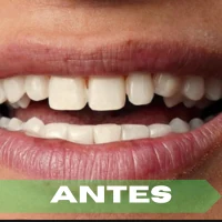 Lentes cerámicos antes