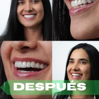 Lentes cerámicos después