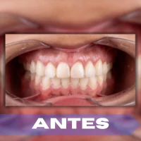 Gingivectomía antes