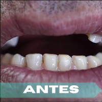 Implantología antes