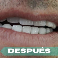 Implantología después