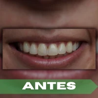Diseño de sonrisa antes