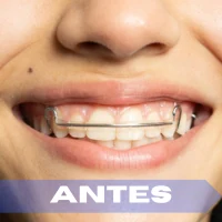 Ortodoncia antes