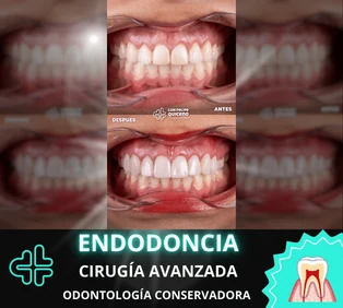 Tratamiento de endodoncia
