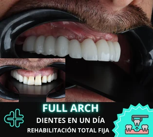Tratamiento Full Arch para rehabilitación completa