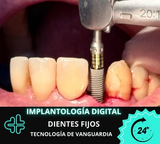 Implantología oral e implantes dentales