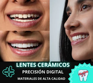 Lentes cerámicos dentales