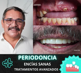 Periodoncia y cuidado de encías